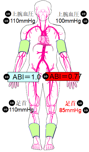血圧測定の図
